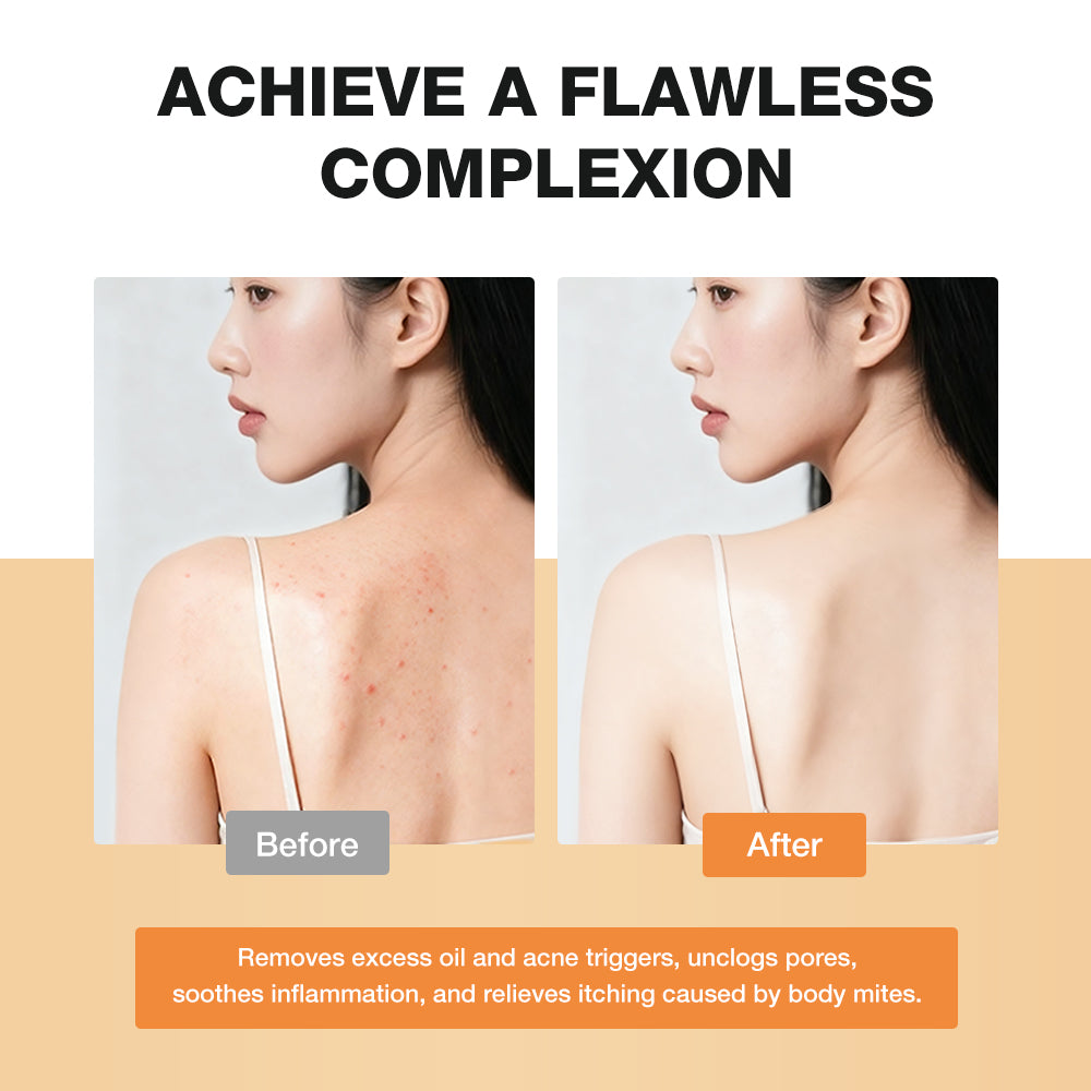 SKINEVER Acne Clearing Body Wash