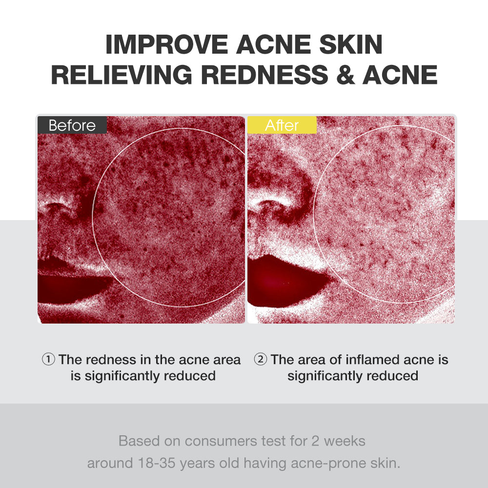 SKINEVER Acne Treatment Ice Sleep Masque