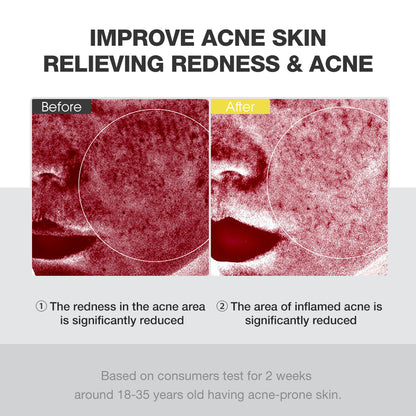 SKINEVER Acne Treatment Ice Sleep Masque